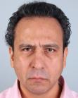 After Hair Transplant &nbsp;Front